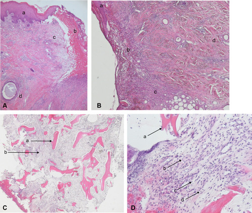 Figure 3 Histo-pathologic picture in of the sternal wound edge and the osteomyelitis of the sternal bone in hematoxylin and eosin staining. (A) In the upper left area the regular skin with its typical configuration is clearly visible (a). On the right side the surface of the wound shows a dermal fibrosis (b) with an subcutaneous edema and thy typical inflammatory cell infiltrate (c) and a local inflammatory reaction along artificial material (d). (B) Shows in a 80x magnification the regular skin area (a), the edema (b), inflammatory cell reaction (c) and the connective tissue (d). (C) Fragments of the sternal bone (a) are surrounded by prominent fibrosis of the medullary canal (b). (D) In the 200x Magnification the bone (a) and the inflammatory sings as fibroblasts (b), lymphocytes (c) and granulocytes (d) are clearly visible.