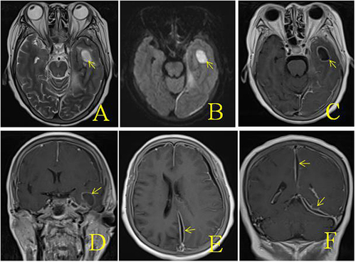 Figure 1 MRI images after admission (A–F): (A) MRI with T2 sequences, (B) MRI with diffusion sequences, (C–F) T1 axial sequence with gadolinium, showing multiple intracranial abnormalities were enhanced, meningitis was considered, and brain abscess in the left temporal lobe was formed, bilateral frontal and left temporo-occipital regions were filled with pus under the skull inner plate and the dura mater of the longitudinal fissure pool, and multiple swelling of the left temporal region.