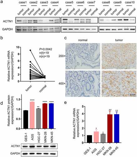 Figure 2. Aberrant expression of ACTN1 on levels of GC tissue and cell line. a Western blotting showed that ACTN1 was up-regulated in 8 of 10 pairs of GC tumor samples (tumor) relative to adjacent normal tumors (normal). b The mRNA level of ACTN1 between 19 pairs of gastric cancer (GC) tumors (tumor) and adjacent normal tumors (normal) by RT-qPCR. c The representative immunohistochemistry of ACTN1 (magnification: 200×; 400×; Scale bars 20um). d-and e. Protein (d) and mRNA (e) levels of ACTN1 between human gastric epithelial cell line (GES-1) and GC cells (HGC-27, AGS, MKN-45, and MKN-28) (P < 0.05 *, <0.01 **, <0.001 ***, <0.0001 ****; GAPDH as loading control for RT-qPCR and WB)