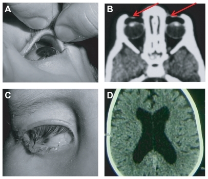Figure 1 (A) Unusually deep upper fornix. (B) Orbital computed tomography showing bilateral enophthalmos and upward bowing of orbital roof with air entrapment (red arrows) under upper eyelid. (C) Copious amounts of mucopurulent discharge from upper fornix. (D) Cerebral computed tomography showing mild enlargement of lateral ventricles.