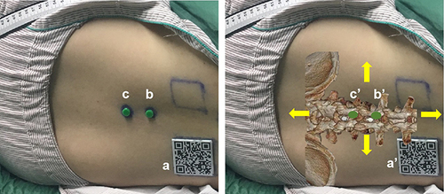 Figure 3 MR-based virtual 3D models automatically adapted to one subject. Left: A subject in the lateral decubitus position with a QR code (a) and two beacons (b/c) affixed to the dorsal skin. Right: The position of the subject’s virtual 3D lumbar model was automatically and manually adapted to match the real lumbar spine. b’/c’: Virtual beacons. Yellow arrows: manual fine-tuning in four directions.