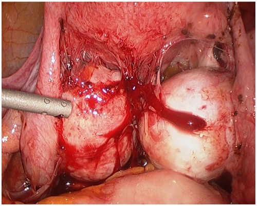 Figure 2 Bilateral endometriomas with obliterated posterior cul de sac.