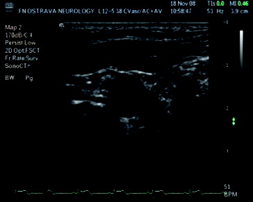 Figure 2. Ultrasonic picture taken from the video signal.