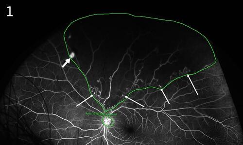 Figure 1 Ultra-widefield mapping on angiographic black retinal ischemia. Ultra-widefield fluorescein angiogram (UWF-FA) shows an identifiable “black retinal ischemia” (black-RI) as the nonperfused retina delineated by a water-shed-border. The digital mappings (demarcated borders) of black-RI and optic disc were generated from an Optos-California model of in-built software function, giving a calculation of Angiographic Retinal Ischemic Index (ARI) as the ratio of the black-RI area against the area of the optic disc. UWF-FA also illustrates retinal neovascularization (short arrow) and retinal microvascular anomalies (long arrows) as numerous tiny hyperfluorescent dots sharing the same water-shed border of black-RI.