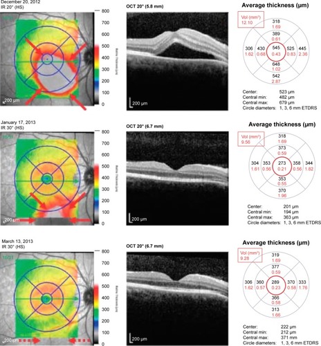 Figure 1 Patient with CSCR, treated with eplerenone 50 mg twice-daily.