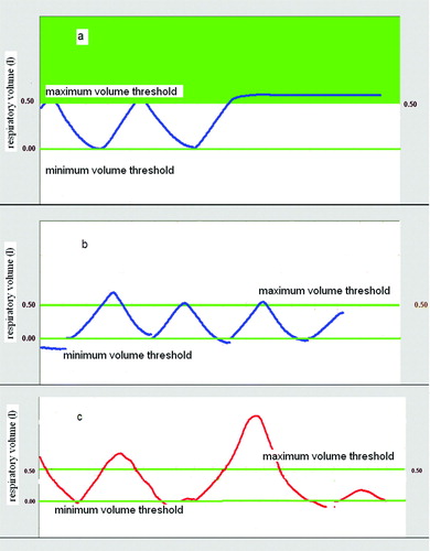 Figure 1.  Active Breathing Control for reproducibility and reduction of respiratory volumes. a) Thresholds at maximum and minimum volumes were set for breath-hold CT scan acquisition. A breath hold at maximum inhale is shown. b) The reproducibility of the breathing volumes was checked during the free breathing CBCT acquisition and treatment delivery. c) Patients were instructed to avoid deep inspiration beyond the maximum threshold level, used for planning CT acquisition.