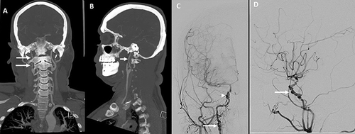 Figure 1 Vascular imaging in a young male patient with a history of right sided amaurosis fugax and right frontal ischemic stroke. Coronal (A) and sagittal (B) views of CT angiogram demonstrate moderate to severe stenosis of the entire right internal carotid artery cervical segment soon after its origin with significant irregularity and beading (white arrows). Anteroposterior (C) and lateral-oblique (D) views on digital subtraction angiogram of right internal carotid artery showed alternate stenosis and dilatation of the extracranial segment (white arrow (C)) and intracranial cavernous-supraclinoid segments (arrowhead (C); white arrow (D)), suggestive of “beading” typical of FMD.