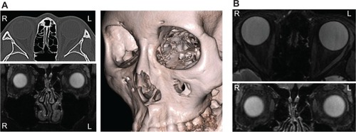 Figure 2 The orbital imaging with CT and MRI at initial visit.