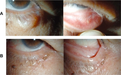Figure 1 Preoperative clinical appearance of the left lower eyelid mass (A) and postoperative clinical appearance of the left lower eyelid lesion (B). The mass was painless and mobile (A) and no recurrence had occurred six months after complete excision surgery (B).
