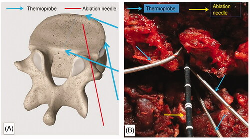 Figure 2. Placement of the ablation needle and thermoprobe. The ablation needle was placed at a 45° angle at the junction between the posterior and anterior edges of the intervertebral disk. The temperature of the posterior, lateral, and anterior edges of the punctured side of the intervertebral disk was monitored during ablation. (A) Diagrammatic sketch. (B) Intraoperative view.