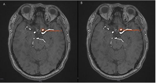 Figure 2 Regions of interest (ROIs) manually depicted along the margin of lesion on MRA sequence by two radiologists independently. The case is a 54-year-old woman with true microaneurysms. ROIs manually depicted along the margin of tumor on MRA sequences by two different radiologists with 3 years’ (A) and 5 years’ experiences (B) in radiology diagnosis independently.