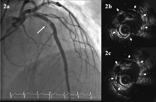 Figure 2.  (a) Coronary angiography showing a similar stenosis with haziness in the proximal LAD six weeks after SES implantation. (b) and (c) Intravascular ultrasound imaging of the stented segment at six weeks of follow-up.