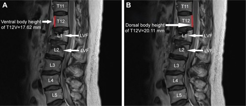 Figure 2 Measurement of ventral and dorsal ventral height was carried out at the T12 vertebra on T2-weighted sagittal MRI images in the LVF group. (A) Ventral body height of T12 vertebra. (B) Dorsal body height of T12 vertebra.