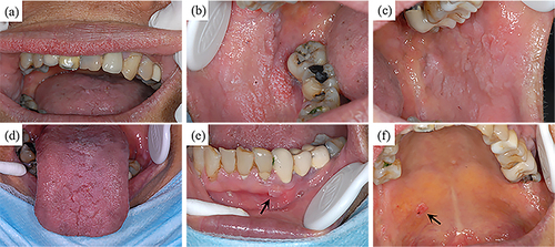 Figure 1 Clinical appearance of the oral cavity revealed extensive papillomatosis of the labial mucosa (a), buccal mucosa (b and c), tongue (d), gingiva (e), and hard palate (f).