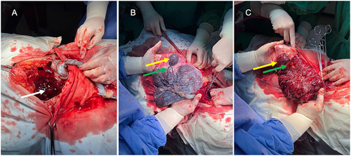 Figure 4 The intraoperative aspect of the placenta. (A) The retroplacental hematoma (white arrow) (B and C) The aberrant placental lobe (yellow arrow) and connecting vessels to the main placental mass (green arrow).