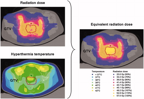 Figure 2. Radiation dose distribution and hyperthermia temperature distribution (left) and resulting equivalent radiation dose (right). Equivalent radiation dose calculation was limited to the GTV only. Temperatures below 37 °C are caused by bolus cooling. For a colour version of this figure, see the online version of this paper.