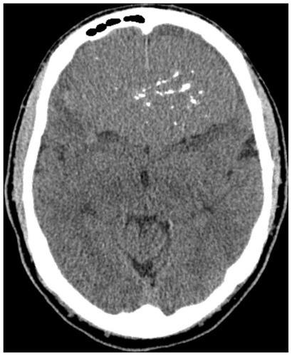 Figure 1 Noncontrast axial computed tomographic image initially identifying a giant, approximately 10 cm hyperdense partially calcified mass encompassing the entire frontal lobe.