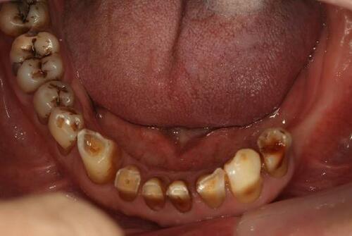 Figure 4 Lower occlusal view (flipped mirror image).