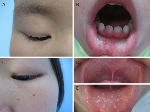 Figure 1 Clinical sign of the proband and his sister. (A) beaded papules on both upper eyelids and (B) isolated papules on the lip of the proband. (C) papules on the eyelids and (D and E) mucosa infiltration of his sister.