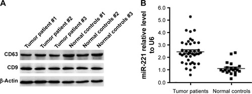 Figure 1 The expression of miR-221 in exosomes of the peripheral blood is closely associated with the prognosis of GC.