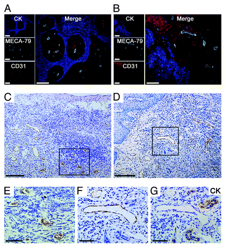 Figure 1. Morphologic characterization of HEV in primary OPSCCs. (A and B) Immunohistochemical staining of CK (AE1/AE3) (blue), MECA-79 (green), and CD31 (red). The MECA-79+/CD31+ blood vessels were detected under the squamous endothelial cells (A) and approximate tumor cells (B). (C) Classic HEVs were located in the lymphocyte-rich areas. (E) high-magnification of the boxed region in (C), classic HEVs kept tall endothelial cells and narrow lumens. (D) HEV-like vessels were adjacent to tumor cells. (F and G) Two consecutive sections of high-magnification of the boxed region in (D). (F) Immunohistochemical staining of MECA-79, HEV-like vessels were dilated and the vessel wall transformed into thin-walled, containing RBC. (G) Immunohistochemical staining of CK (AE1/AE3), which indicated tumor cells. Bar, 100 μm (A and B); 200 μm (C and D), and 50 μm (E–G).
