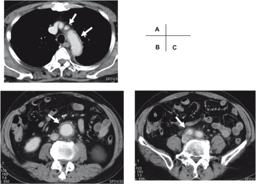 Figure 1 Contrast computed tomography showed the periaortic enhancement and dirty fat sign (white arrow), at the level of aortic arch and its branches A) abdominal aortic aneurysm, B) and common iliac arteries C).