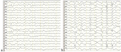 Figure 3. Results of the second EEG.The second EEG was performed at 2 months after onset of the movement disorder, and a week after the first EEG. The results of the two EEG examinations were similar. a demonstrates abnormal waves in the background. b displays sharp waves, sharp slow waves, and slow waves that are discharged synchronously or asynchronously at the bilateral occipital and frontal region.