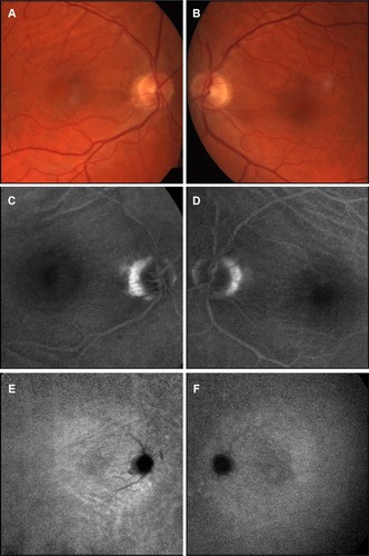 Figure 2 Composite fundus images.