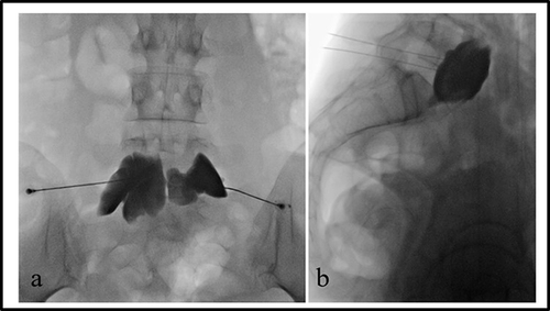 Figure 2 Superior hypogastric plexus neurolysis in a patient with ovarian cancer-related pelvic pain.