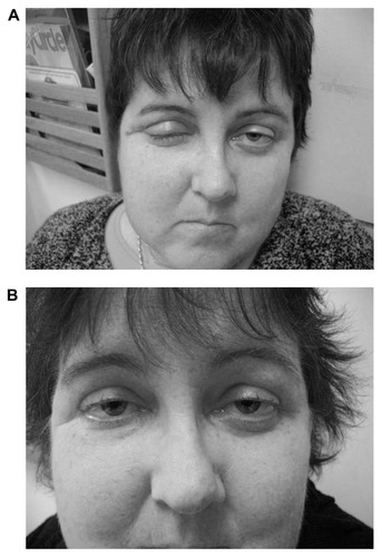 Figure 1 Patient 7 with retroorbital mass found to have noncaseating granulomas consistent with sarcoidosis. First image (A) shows eye swelling prior to rituximab therapy. Patient also had active anterior uveitis. She was treated with 60 mg prednisone a day and methotrexate. Second image (B) shows marked reduction of eye swelling after 6 months of rituximab therapy. Anterior uveitis had resolved. Patient had been able to reduce their dose of prednisone to 10 mg a day and continued on methotrexate. Patient provided written consent for publication of these photographs.