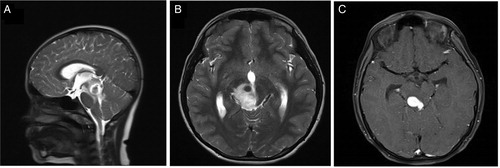 Figure 1. Pre-treatment magnetic resonance imaging with coronal (A) and sagittal T2 (B) with contrast (C) images showing intensely enhancing lesion in the right midbrain.