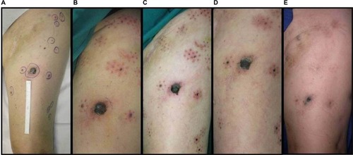Figure 1 Clinical response of melanoma metastases after ECT (patient 1): (A) before treatment; (B) 3 days; (C) 10 days; (D) 1 month; (E) 2 months.