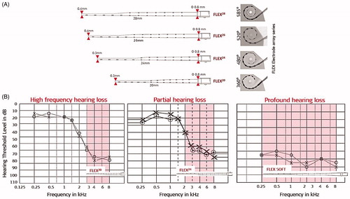 Figure 3. FLEX electrode array series with different array lengths (in addition to the previously mentioned FLEXSOFT™), offering various angular insertion depths (A). Audiograms of various hearing loss conditions and proposed electrode array lengths (B). Image courtesy of MED-EL.