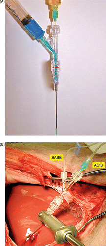 Figure 1 Device in vitro and in vivo. (A) Device with blue (side port) and yellow (coaxial port) coloured water in channels demonstrating concept in which the two solutions mix near the tip and the resulting green solution exits the tip of the device. This earlier prototype is a simple end hole design, whereas the device used in this study (next image) had a solid tip with three side holes created near it for egress of the heated salt solutions. (B) Experimental set-up showing liver surgically exposed, the device ready for use with the base entering via the side arm of the rotary haemostatic valve and acid entering via the coaxial green hub needle. During simultaneous injection, the reagents mix near the tip and exit as a hot, hyperosmolar salt solution. The thermocouple is not yet positioned.