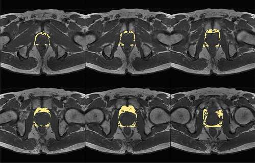 Figure 1. Measurement of PPAT volume on multiple T1-weighted slices. PPAT: periprostatic adipose tissue.