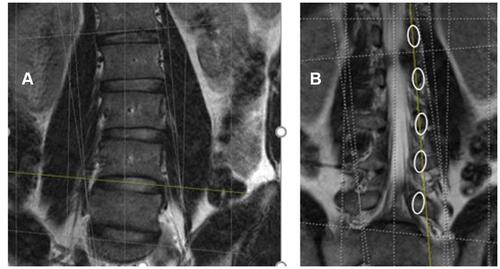 Figure 11 Rotated subect with coronal oblique and parallel endplate MRI slices (Rot-COPE). (A) represents a coronal image with axial cut line (yellow) through L45 with adjustment for endplate correction. (B) demonstrates a coronal image with parasagittal cut line (yellow) commensurate with upper pedicles only.