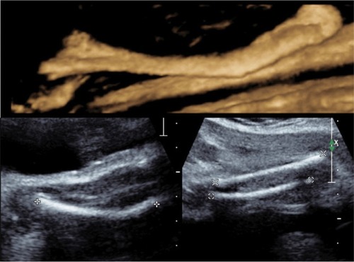 Figure 2 2-D image showing femoral angulation compared to straight distal long bones (tibia and fibula) with superimposed 3-D rendering of the femoral shaft.