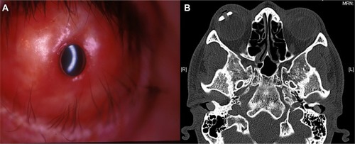 Figure 10 Postoperative course after stage 2.