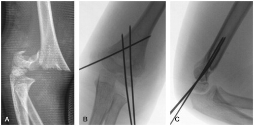 Figure 1. A. A 6-year-old boy with a Gartland grade-III extension-type supracondylar fracture. B and C. Satisfactory reduction and pin fixation in both the frontal plane (Baumann angle) (B) and the sagittal plane (C) (AHL crosses ossification center of capitellum).