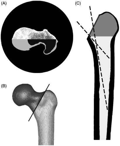 Figure 1. (A) Transversal view of the proximal part of a femur obtained by a CT scan. The lower half shows the selection masks for spongious (black) and cortical bone (light grey). (B) 3D model of the femur, showing the planed osteotomy in 45°. (C) Frontal view of the femur with removed femoral head. Working principle of the simulation program: The dashed lines show two possible configurations of the virtual instrument entering from the osteotomy into the femoral canal. The dark grey area was not considered in the simulation.