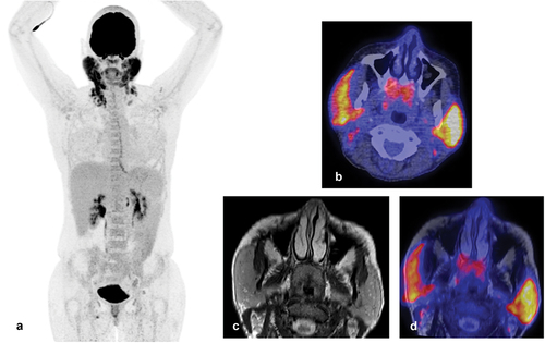 Figure 4. (a) Whole-body 18F-fluorodeoxyglucose(FDG) positron emission tomography/computed tomography (PET/CT) scan of the same patient as in figure 3a/b. Intense FDG-uptake is observed in both parotid glands and in the neck region. (b) FDG-PET/CT image showing increased uptake in both parotid glands and cervical lymph nodes. In addition, physiological FDG-uptake in the adenoids is observed. (c) T2 Magnetic resonance image (MRI) image showing diffuse enlargement of both parotid glands associated with MALT lymphoma. Figure 4d: Fused transversal FDG-PET/MRI image.