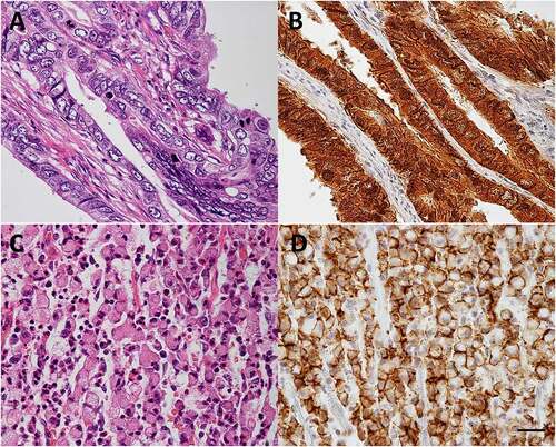 Figure 2. Claudin-18.2 expression in gastric cancer.