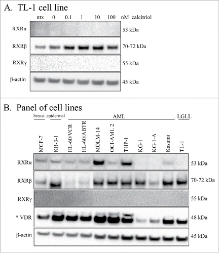 Figure 5. RXR isoform distribution in LGLL and other cell lines. Lysates from the experiment in Fig. 3 were run on independent blots and probed for the 3 RXR isoforms. Total protein loaded per sample was 25 μg, with β-actin used as a loading control. The TL-1 cell line (A) was probed for the RXR isoforms: α, β, and γ. (B) Western blotting of lysates from MCF-7, KB-3-1, 9 AML cell lines, and the TL-1 cell line was performed for the RXR isoforms (α, β, and γ), and VDR. The VDR blot is shown overexposed (denoted by *) to visualize the 54 kDa isoform. One AML cell line lysate was degraded and therefore was cropped out of this blot.