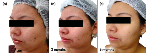 Figure 4 Case study 2 improvement on left-hand side of face, baseline to 6 months (a) Baseline (b) 3 months with AZA 15% gel twice daily (c) 6 months with AZA 15% gel twice daily.