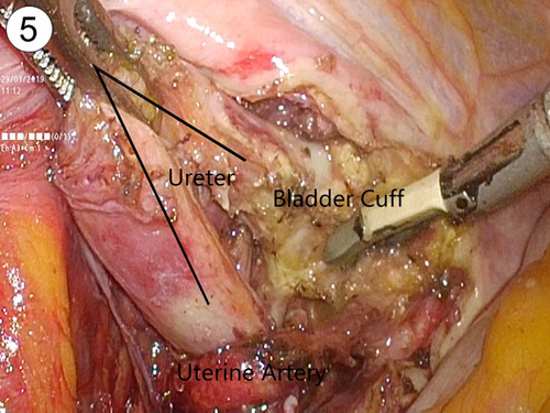 Figure 5 Dissection of distal ureter and bladder cuff through transperitoneal approach. The ureter was dissected caudally to the bladder wall and was excised with a cuff of bladder around the ureteric orifice.