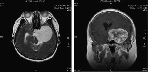 Figure 1. MRI imaging showed demarcated bell-shaped.