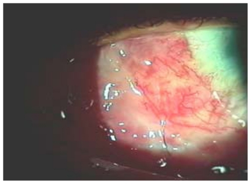 Figure 1 Postoperative photograph of a case of Group
