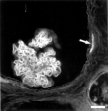 FIG. 3 Fluorescence micrograph of a glomerular cyst stained with the FITC-conjugated lectin WGA. Note segmental staining of the parietal basement membrane (arrow) and the cell coat of visceral podocytes is strongly positive and parietal podocytes have weaker staining. Bar = 200 μm.