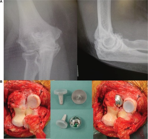 Figure 11 (A) Anteroposterior and lateral radiographs of an elbow demonstrating the characteristic appearances of primary (hypertrophic) osteoarthritis. Prominent osteophytes can be seen arising from the tip of the coronoid and olecranon, which has been interpreted as evidence of osteoarthritic change involving the ulnohumeral joint. (B) Left: intraoperative photograph of this patient demonstrating the degenerative changes (loss of articular cartilage) is confined to the radiocapitellar joint; the ulnohumeral joint surfaces are healthy. Middle: radial and capitellar components of an LRE. Right: intraoperative photograph following insertion of the LRE components.