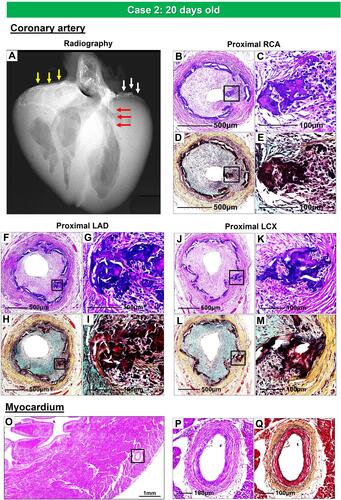 Figure 5 Radiography and histologic images of the coronary arteries and myocardium from a 20-days-old female infant with GACI. Radiograph of the heart shows calcification of the major coronary arteries: RCA (yellow arrows), LAD (red arrows), and LCX (white arrows) (A). Proximal RCA (B–E), proximal LAD (F–I), and proximal LCX (J–M) show moderate to severe luminal narrowing with circumferential calcification of IEL. Images B, C, F, G, J, and K of coronary arteries are stained with hematoxylin and eosin and Movat Pentachrome D, E, H, I, L, and M, stains, respectively. The boxed areas in the left panels, B, D, F, H, J, and L, are shown at high power in the right panels, C, E, G, I, K, and M. Panels C and K show bone metaplasia within calcified areas. Histologic section of the left ventricular wall showing normal histology of the intramyocardial coronary arteries [boxed area in (O); note an absence of calcification and intimal proliferation (P and Q)]. (O and P) are stained by hematoxylin and eosin; (Q) is stained by Movat pentachrome stain.